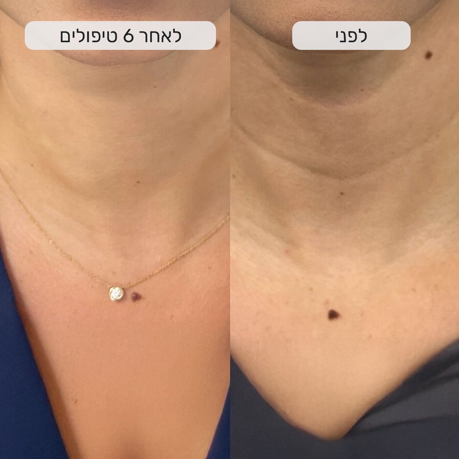 ערכה בייתית לחידוש העור ושיפור מראה הקמטים - Fiks™