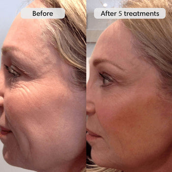 Fiks™ Micro Infusion System