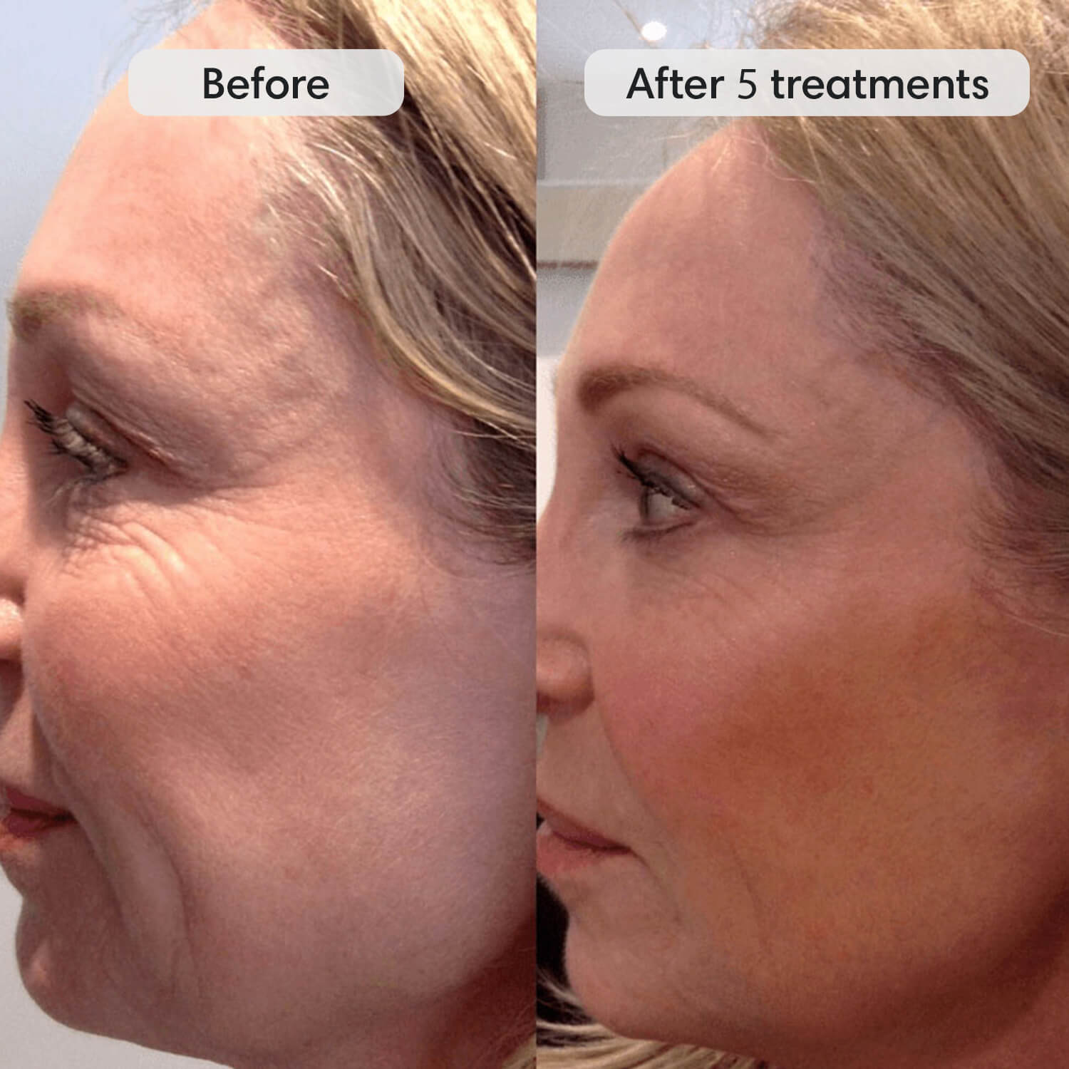 Fiks™ Micro Infusion System