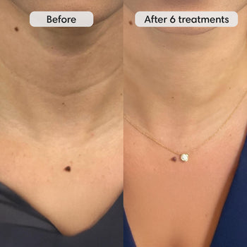 Fiks™ Micro Infusion System