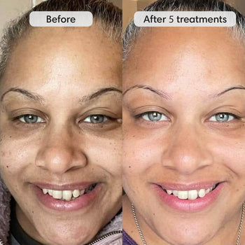 Fiks™ Micro Infusion System