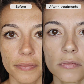 Fiks™ Micro Infusion System