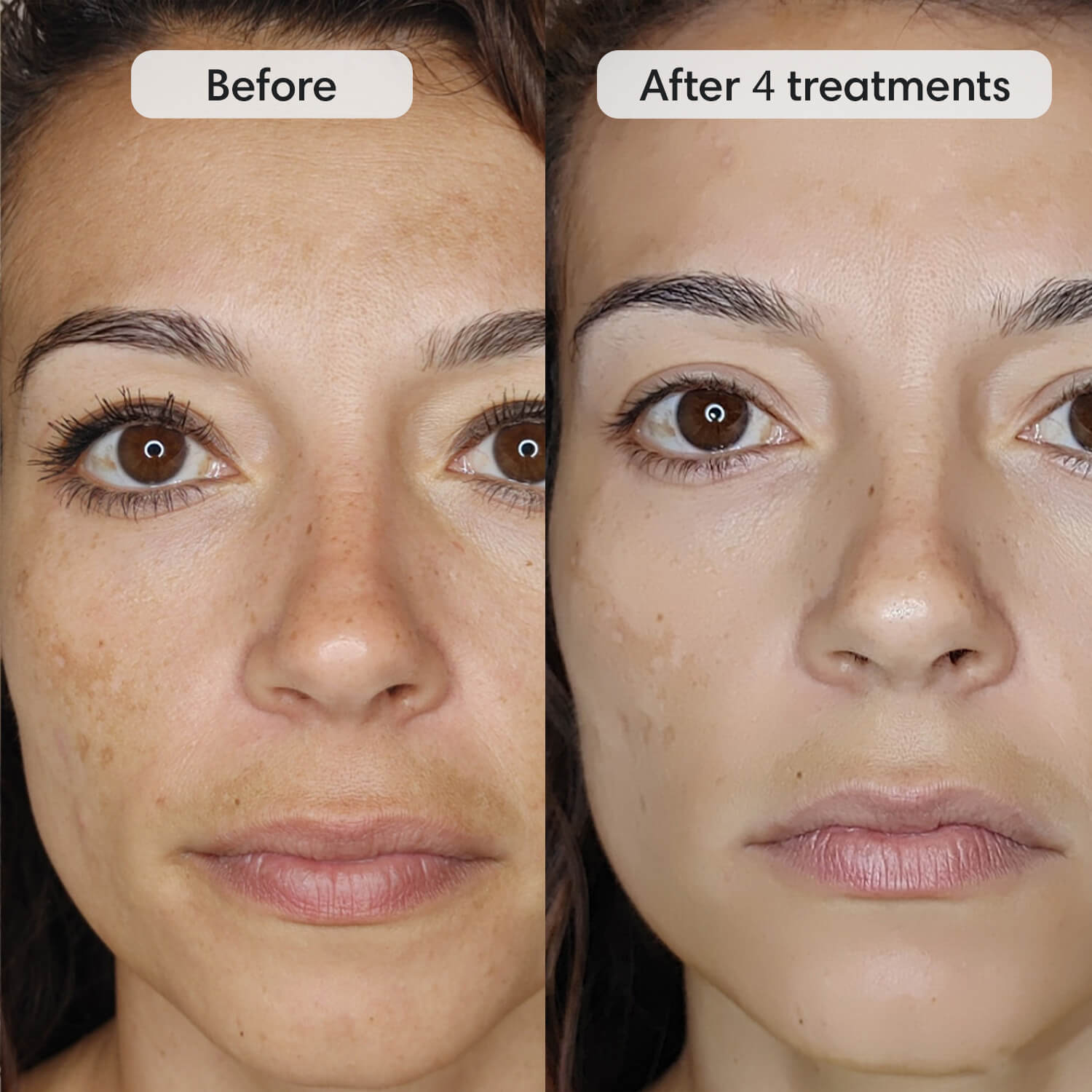 Fiks™ Micro Infusion System