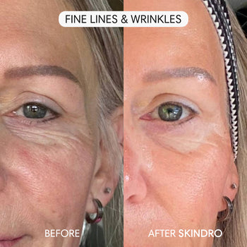 Skip the Filters: Embrace a New Level of Confidence with Skindro
