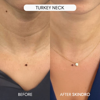 Skip the Filters: Embrace a New Level of Confidence with Skindro