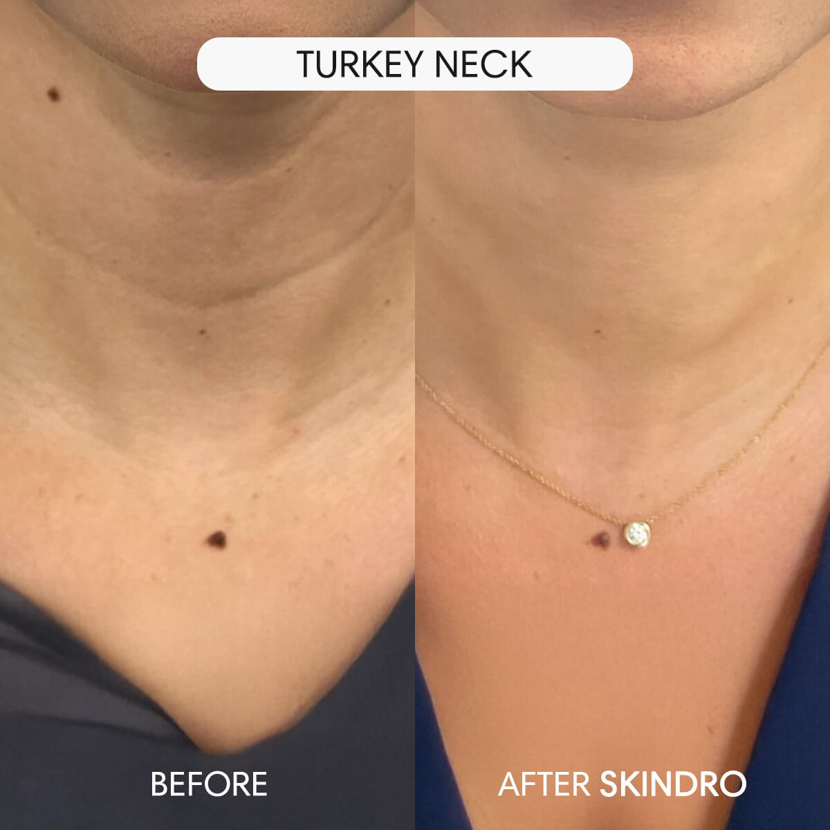 Skip the Filters: Embrace a New Level of Confidence with Skindro